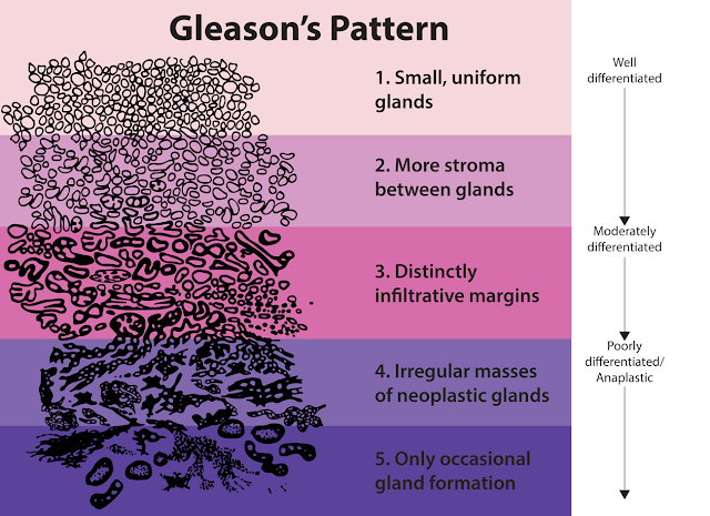 谷歌AI系统可对前列腺癌细胞进行分级 准确率达70%