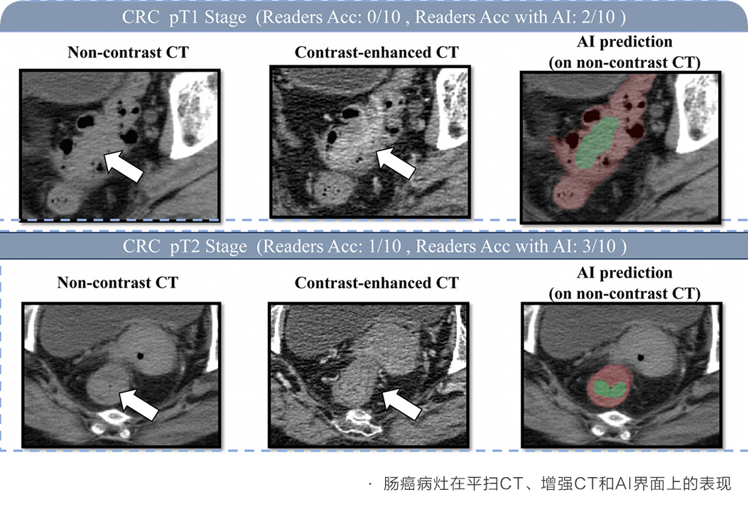 阿里达摩院 AI 全球首次实现肠癌“无感”检测，登上国际肿瘤学顶刊